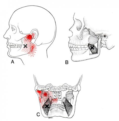 medial pterygoid Travell and Simons
